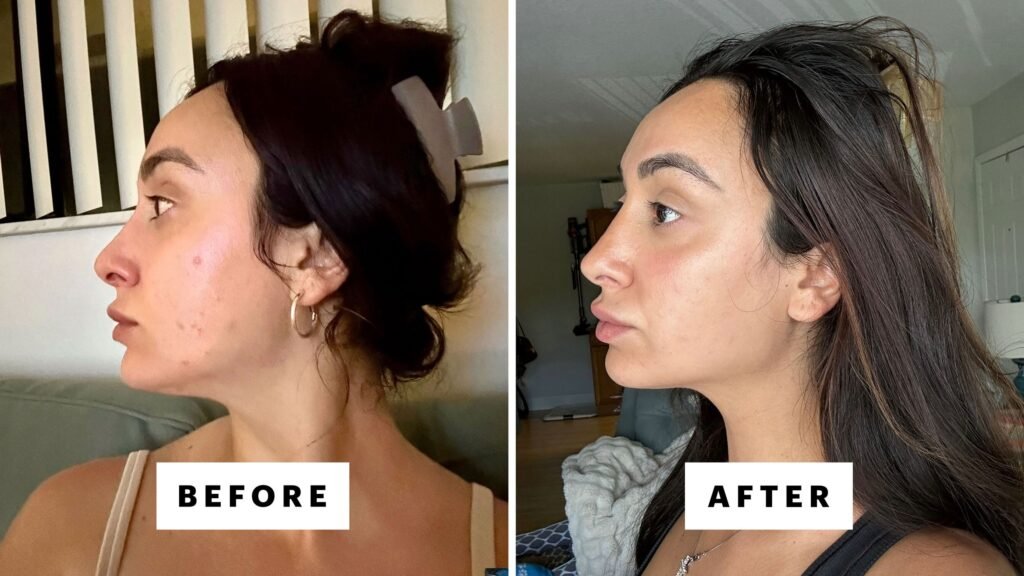 3 Best Dark Spot Correctors for Acne Scars, Melasma, and More