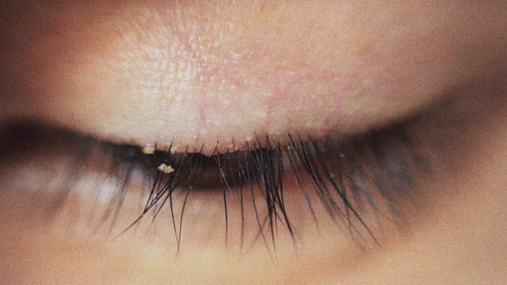 Eyelash Mites: Symptoms, Causes, and How to Treat Them Eyelash Mites: Symptoms, Causes, and How to Treat Them