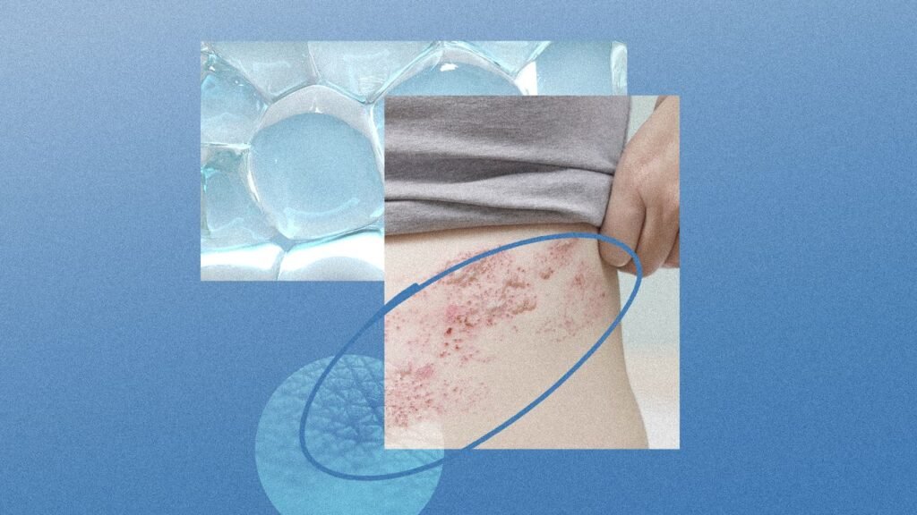How to Prevent Long-Term Skin Damage from Shingles