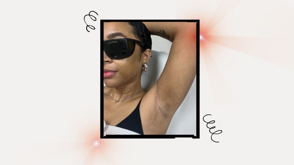 How I’m Preventing Hyperpigmentation During Laser Hair Removal
