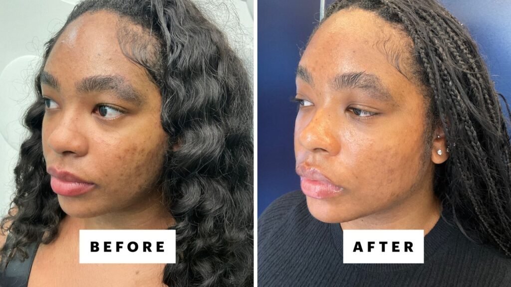 Does Laser Genesis Really Live Up to the Hype?
