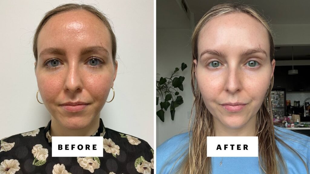 Can You Use Azelaic Acid With Tretinoin? Dermatologists Weigh In. Can You Use Azelaic Acid With Tretinoin? Dermatologists Weigh In.