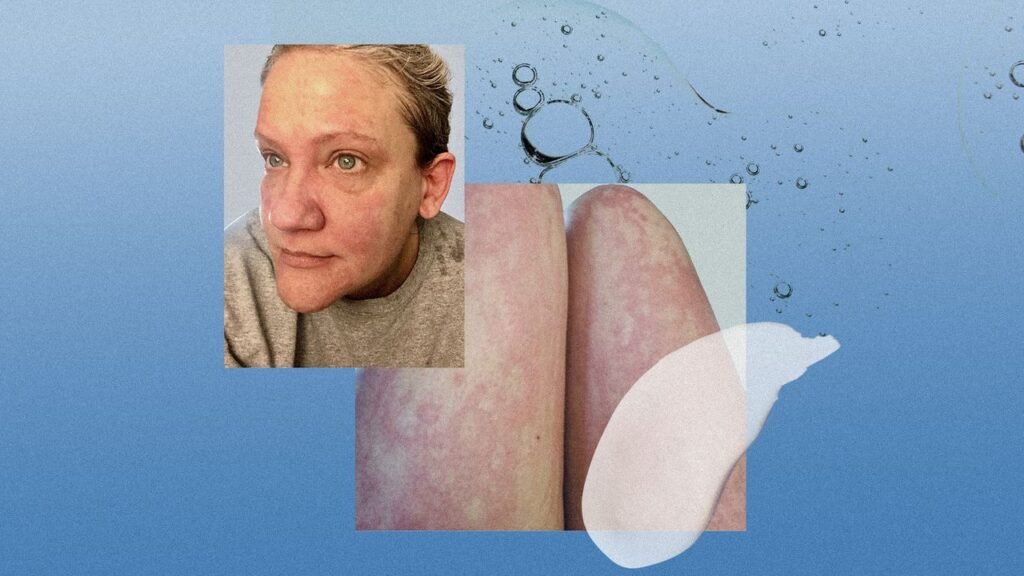 I Had Chronic Hives for Decades Before Learning What Was Really Causing Them