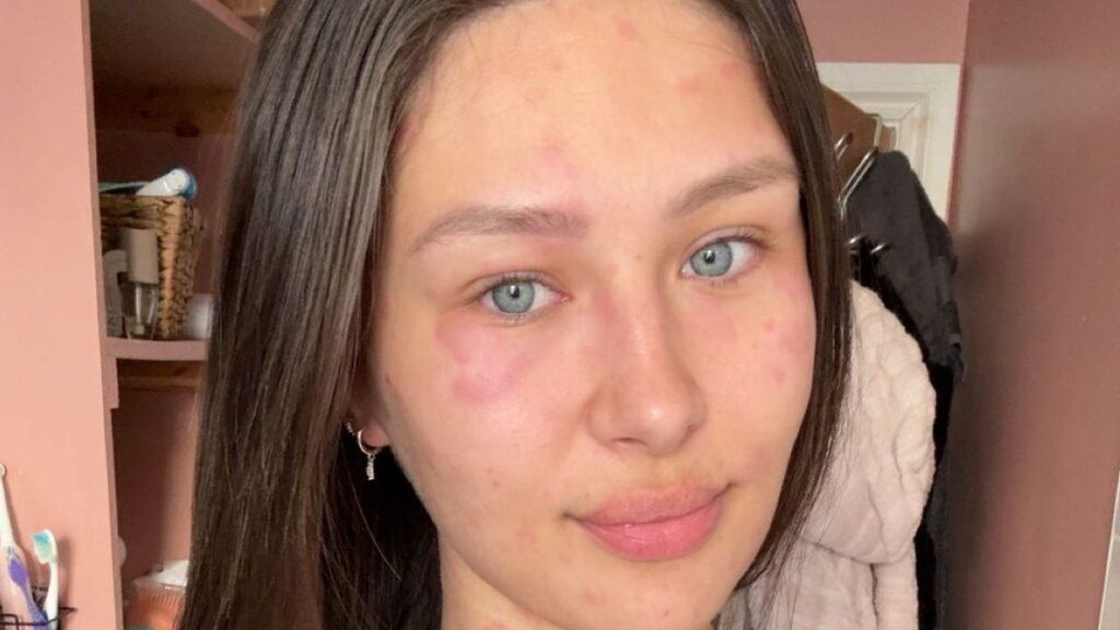 I’m a Beauty Pageant Winner with Chronic Hives. This is What It’s Like I’m a Beauty Pageant Winner with Chronic Hives. This is What It’s Like